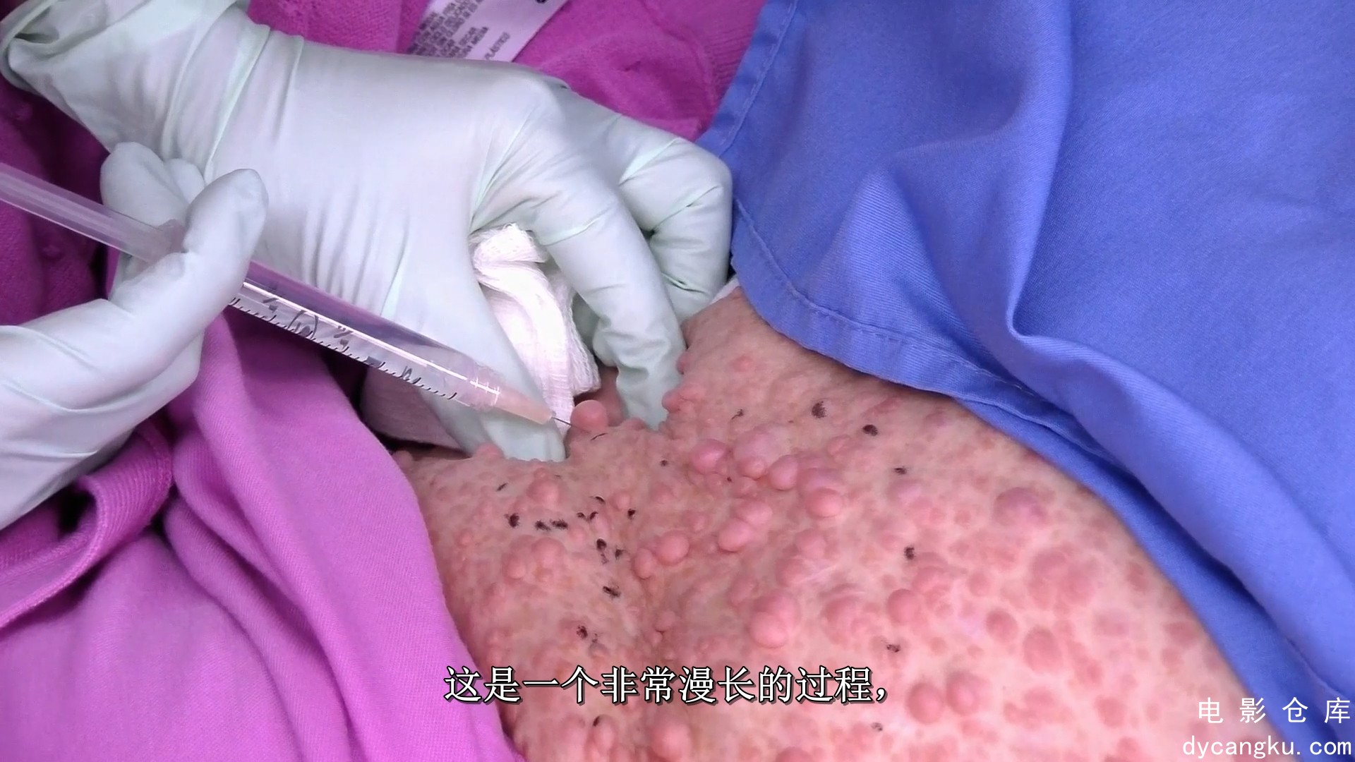 [电影仓库dycangku.com]Dr Pimple Popper_S01E04_The Curious Case of the Pooting Cy.jpg